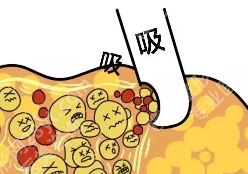 上海九院抽脂价格是多少？1.2w元起，让你轻松摆脱顽固脂肪