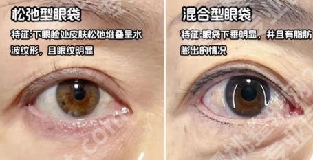 山东省立医院去眼袋哪个医生技术好些？各大专家资质对比！