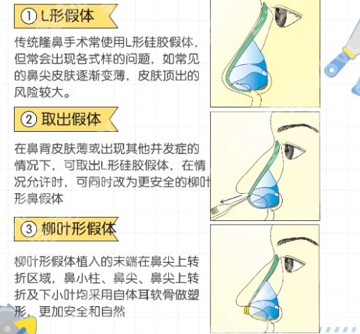 北京301医院做鼻子怎么样？从案例到口碑全解析！