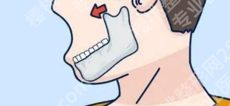 山东省立医院磨骨价格贵不贵？均价6w起？戳进来看详情