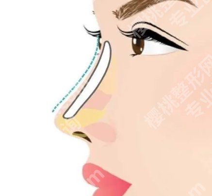 浙医二院隆鼻多少钱？硅胶/膨体/自体脂肪等差别很大哦！