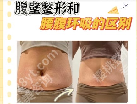山东省立医院吸脂案例展示！让你重拾自信恢复理想身材！
