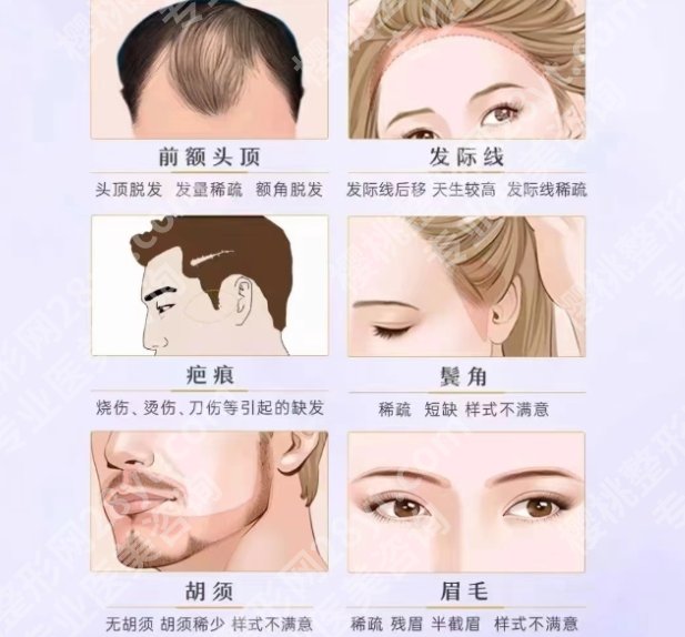 成都华西植发怎么收费的?价格贵不贵？细节展示！