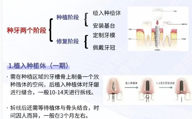 深圳北大医院牙齿种植价格参考！一篇解析让您不花冤枉钱！