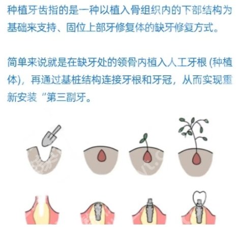 南方医院种植牙收费标准！附术前就诊须知！收藏再看