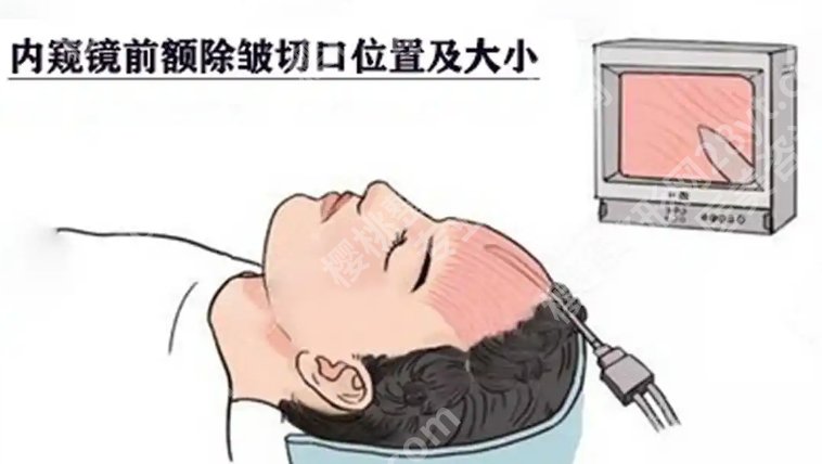 安徽省立医院除皱多少钱？玻尿酸、超声炮等多种方式可选！附价格