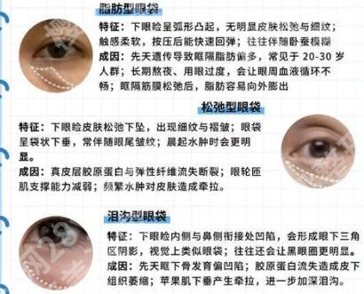 北医三院祛眼袋手术多少钱？效果好不好？案例图展示！
