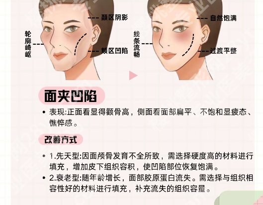 北医三院脂肪填充怎么样？面部年轻化效果解析！