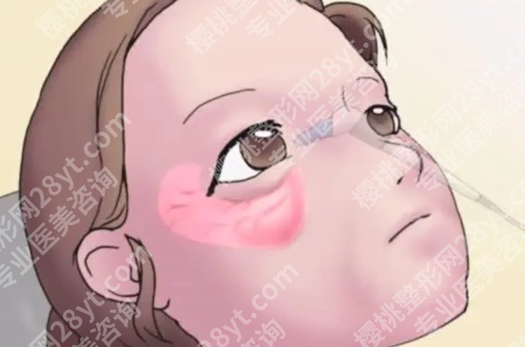 深圳北大医院祛眼袋咨询|眼袋项目常见问题你问我答！