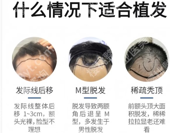 北医三院植发多少钱？热门项目推荐|真人案例反馈！