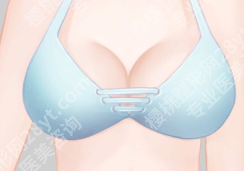西京医院自体脂肪填充隆胸丰胸多少钱？1.8万元起，一文讲述更多重点