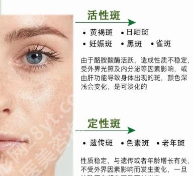 南方医院皮秒祛斑效果怎么样？真人案例对比|优缺点总结