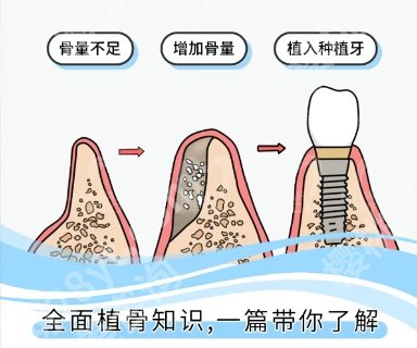 山东省立医院种牙费用贵不贵？全新费用明细等你来看！
