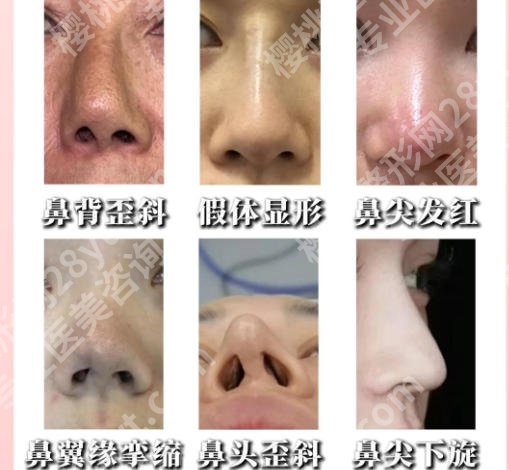 温州鼻修复好的医生有哪些？红榜优选，技术&审美双全！