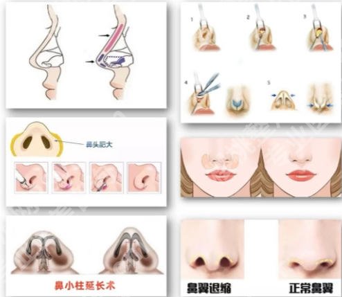 上海做鼻综合哪个医生好?闵沛如、宋楠、陈付国等医生实力大测评!