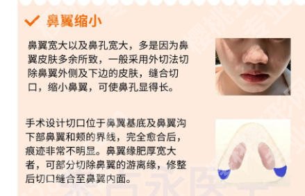 贵阳隆鼻哪个医生好?孙豫苏、唐修俊隆鼻做得好,值得信赖!