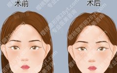 南方医院做下颌角手术价格，公立医院价格区间整理