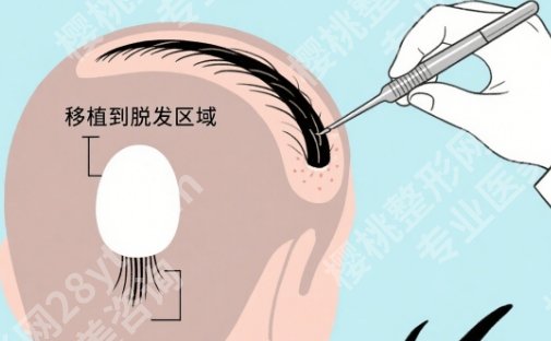 华西植发效果怎么样？医生经验与整体审美一次说明白