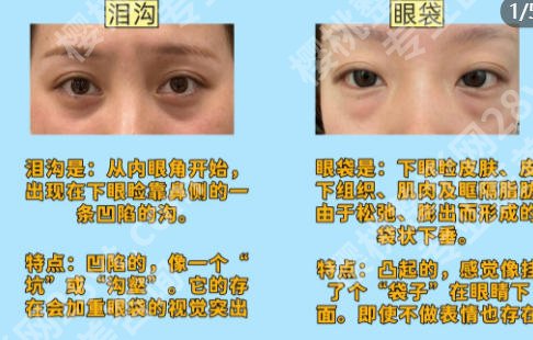 邢台哪里去眼袋手术做得好?求推荐经验丰富的医院!