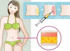 浙二抽脂什么价格？价格范围先提前摸清