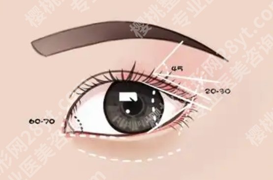 浙江二院割双眼皮怎么样?医生风格和口碑体验先看看