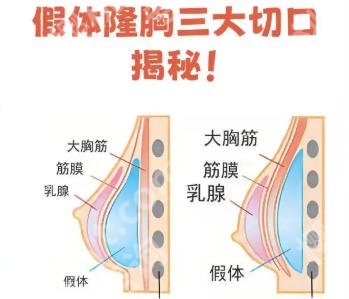 成都华西医院丰胸手术价格更新!假体隆胸低至4w起!透明收费不踩坑