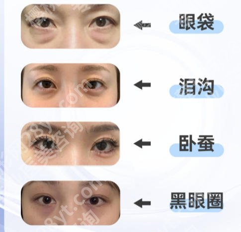 大连祛眼袋的整形医院有哪些？上榜有大连爱德丽格、大连艾加艾等五家医院