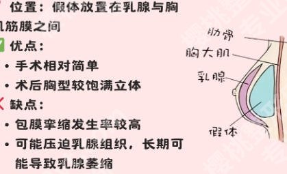 上海九院丰胸价格材料怎么样？专家手把手教你不踩坑！