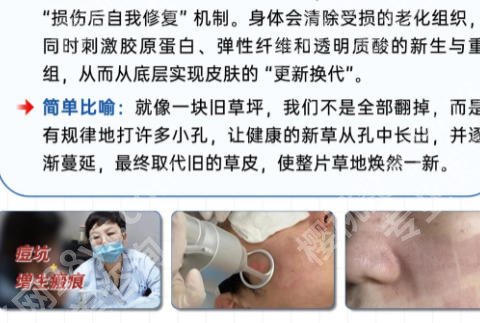 宿迁点阵激光多少钱一次?低至3k元起价格透明!