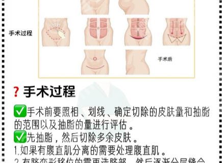哈医大一院腹壁整形专家排名怎么样?王牌项目与医生选择指南来了！