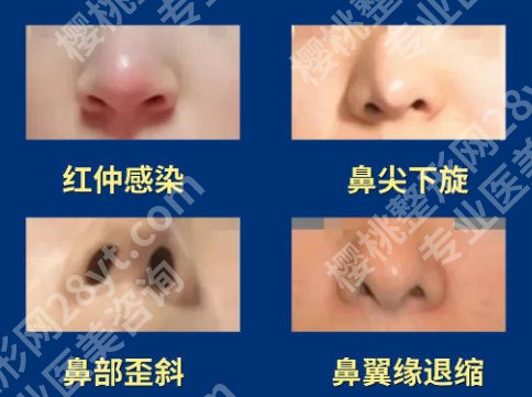 厦门做鼻子比较出名的医生(专家)有哪些?卢艺朴、廖立新等医生实力超群!