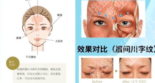 宜昌除皱注射多少钱？2026年新价目表、医院选择指南与省钱技巧全解析！