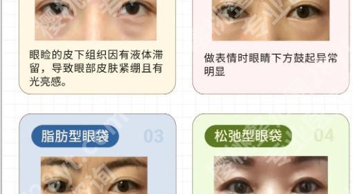 泰安祛眼袋医院哪家好?2026年本地Top5口碑医院与医生技术实力盘点!