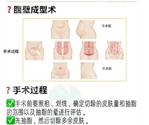 上海九院腹壁整形谁做得好?排名靠前医生名单公布!