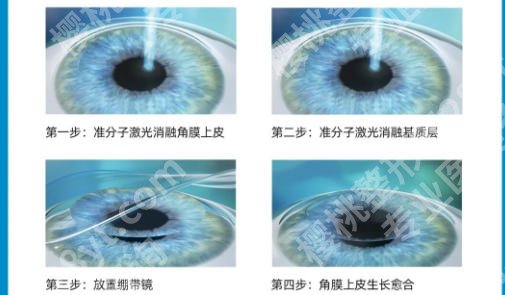 衢州激光近视哪里好？衢州市、江山市人民医院深度评测，附2026年激光近视价格详情参考 