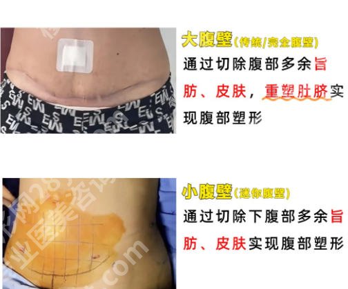 厦门中山医院腹壁整形专家有哪些？这几位医生都不错含真实案例分享！