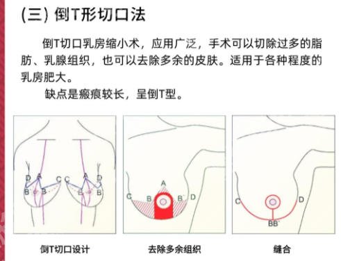 四川成都华西医院缩胸术案例详解！从医生、技术、案例和价格来分析！