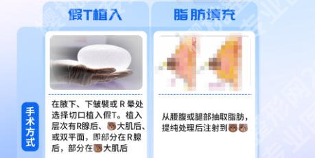 北京联合丽格隆胸怎么样?杨大平和罗忠振教授隆胸案例与价格全指南!