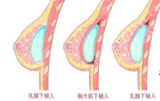 成都新丽美隆胸多少钱?2026收费标准公布!韩式隆胸7200元左右!