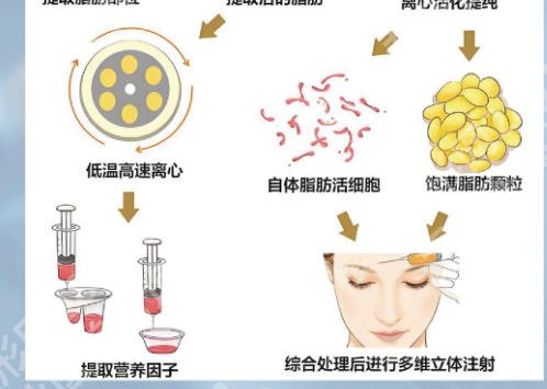 北京玉之光脂肪填充怎么样?附医生技术详解及真实案例分享!