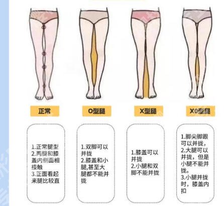 北京知音整形o型腿怎么样？这些优势项目您可知道？想了解的千万别错过！