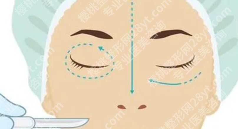 葫芦岛割双眼皮哪家好？做眼部项目时常见选择都整理出来了