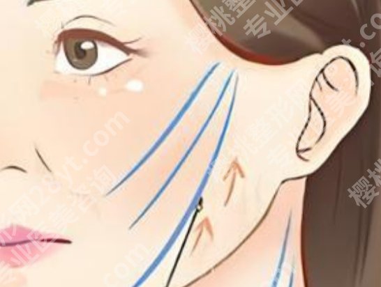 哈尔滨拉皮手术费多少钱?手术价格高低通常差在这几项