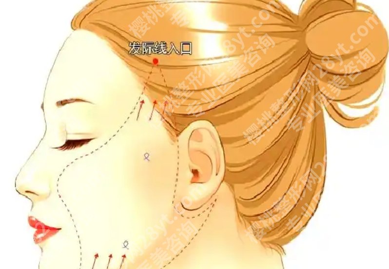 哈尔滨拉皮手术价格是什么?收费到底怎么看,这篇说得更直白