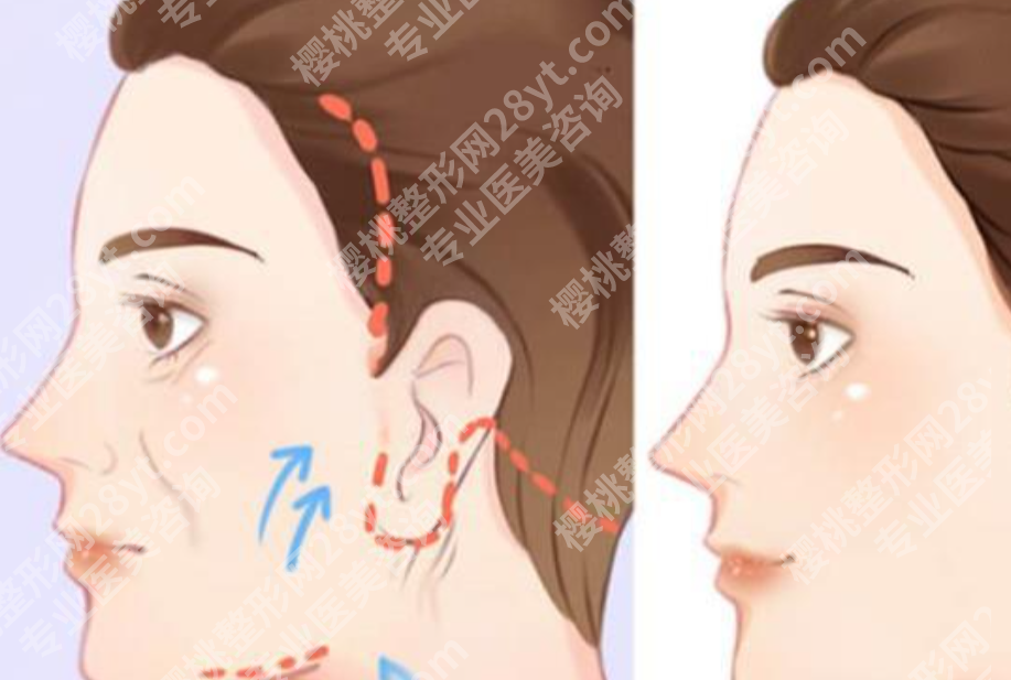 哈尔滨拉皮手术好的医生有哪些?技术、经验和面部审美风格都值得细看