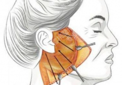 齐齐哈尔拉皮哪家做得好？从审美到恢复反馈，几个重点都替你整理了