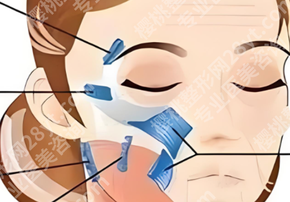 长春做拉皮多少钱?费用区间、影响因素一次讲明白