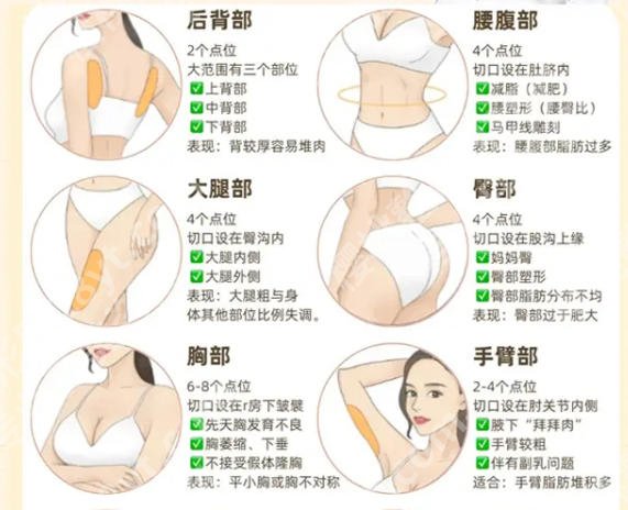 海峡刘歆医生技术怎么样？吸脂经典案例展示|含价格