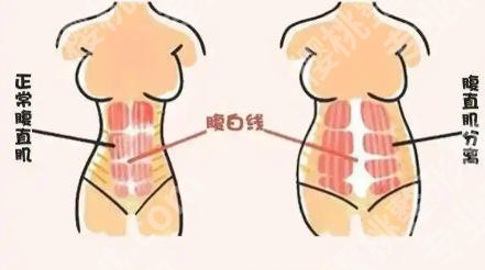 展望医生腹壁整形技术如何?医生资质点评!附案例