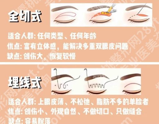 潘峰医生擅长领域介绍!做双眼皮怎么样?真实反馈来了